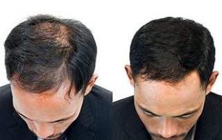 Neograft FUE Hair Transplant Jacksonville FL