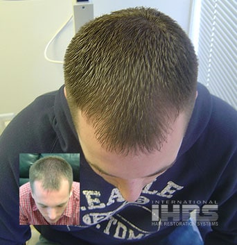 Laser Hair Therapy Treatment for Hair Loss Jacksonville FL
