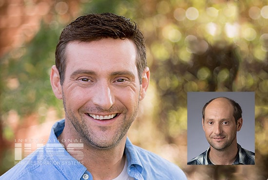 Men's Hair Replacement - Jacksonville, FL