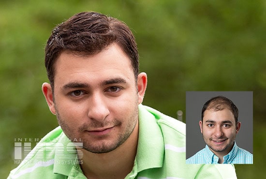 Men's Hair Replacement - Jacksonville, FL