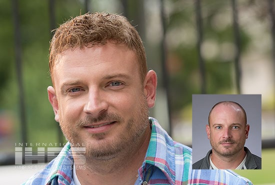 Men's Hair Replacement - Jacksonville, FL