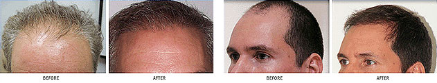 Neograft FUE Hair Transplants Jacksonville Clinic