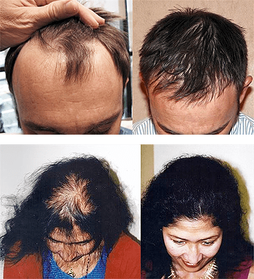 Hair Transplants Medical Hair Restoration Jacksonville Fl