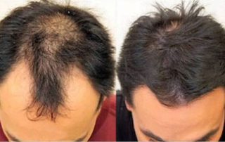 Jacksonville FUE Hair Transplants