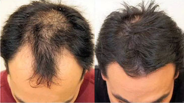 Jacksonville FUE Hair Transplants