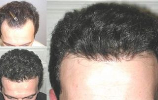 Jacksonville Hair Teransplant surgeon
