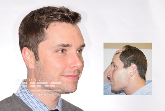 PAI advanced hair transplants Jacksonville FL