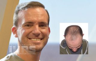 pai multi unit hair transplantation jacksonville fl