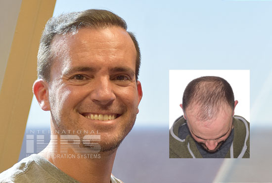 pai multi unit hair transplantation jacksonville fl