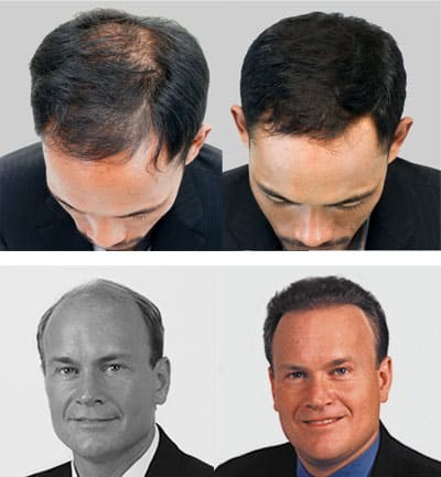 FUE Hair Transplants Explained IHRS Jacksonville Florida Hair