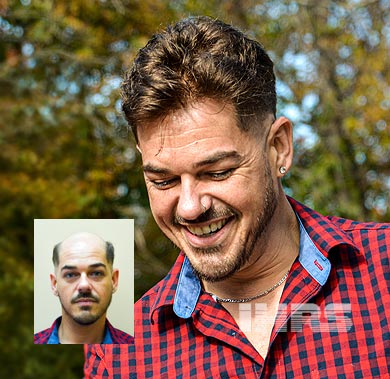 A man with neatly styled dark hair and a trimmed beard looks to the side. Inset shows the same man before, with significant baldness on top of his head—demonstrating the transformation possible with Men's Hair Replacement Systems in Jacksonville, FL. 